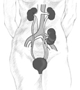 Anatomical diagram of a female figure with a transplanted kidney. The two diseased kidneys are still in place on either side of the spine, just below the rib cage. The transplanted kidney is located on the left side, just above the bladder. A transplanted ureter connects the new kidney to the bladder.