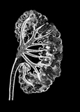 Drawing of a medullary sponge kidney as seen in an intravenous pyelogram. The background is black. The large part of the kidney appears to be porous, like a sponge.