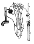 Drawing that shows a microscopic view of a nephron with cysts. Blood vessels are shown on the left side of the picture. A urine-collecting tube is shown on the right side of the picture. In the middle, branching blood vessels intertwine with the branching urine-collecting tubes. The larger urine-collecting tube on the right is covered with fluid-filled sacs called cysts.