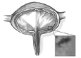 Ilustracion de la seccion transversal de una vejiga con un cistoscopio visible en la uretra. Un recuadro muestra una seccion agrandada de la pared de la vejiga interior donde visiblemente se ensena sangrado.