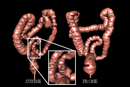 Computerized Tomographic Colonography (CTC) images of a colon