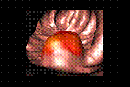 Virtual colonoscopy image of the inside of a colon