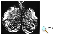 Digital mammography