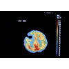 PET Scan 3