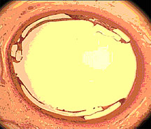 The biodegradable stent in this pig coronary artery is fully expanded and in contact with the artery wall. Studies show that the stent causes negligible inflammation and blood clot formation.