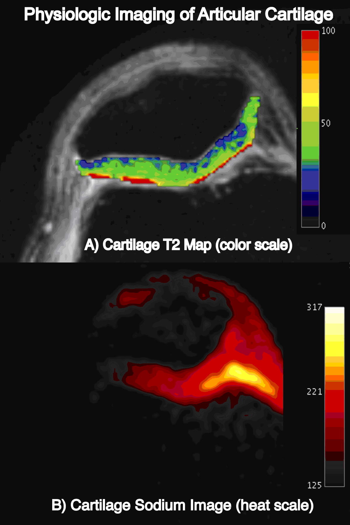 MRI has the capability to provide both structural and physiologic information that is more sensitive to early degenerative changes in cartilage.