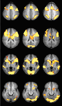 3 Cloumns of different brain scans.