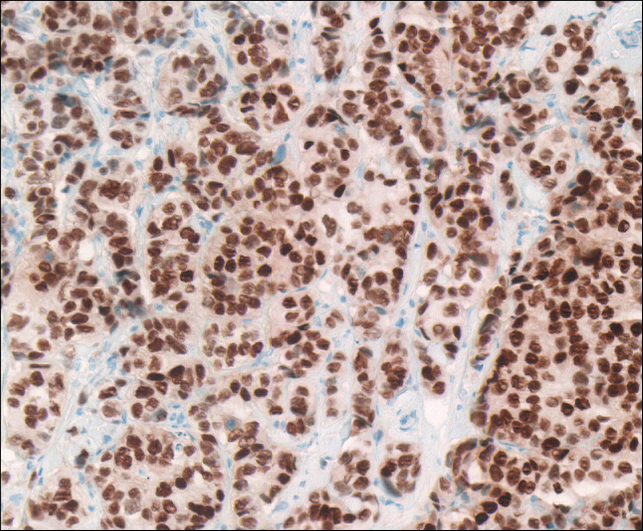 Estrogen receptor-positive breast cancer pathology specimen viewed as DMetrix virtual slide.