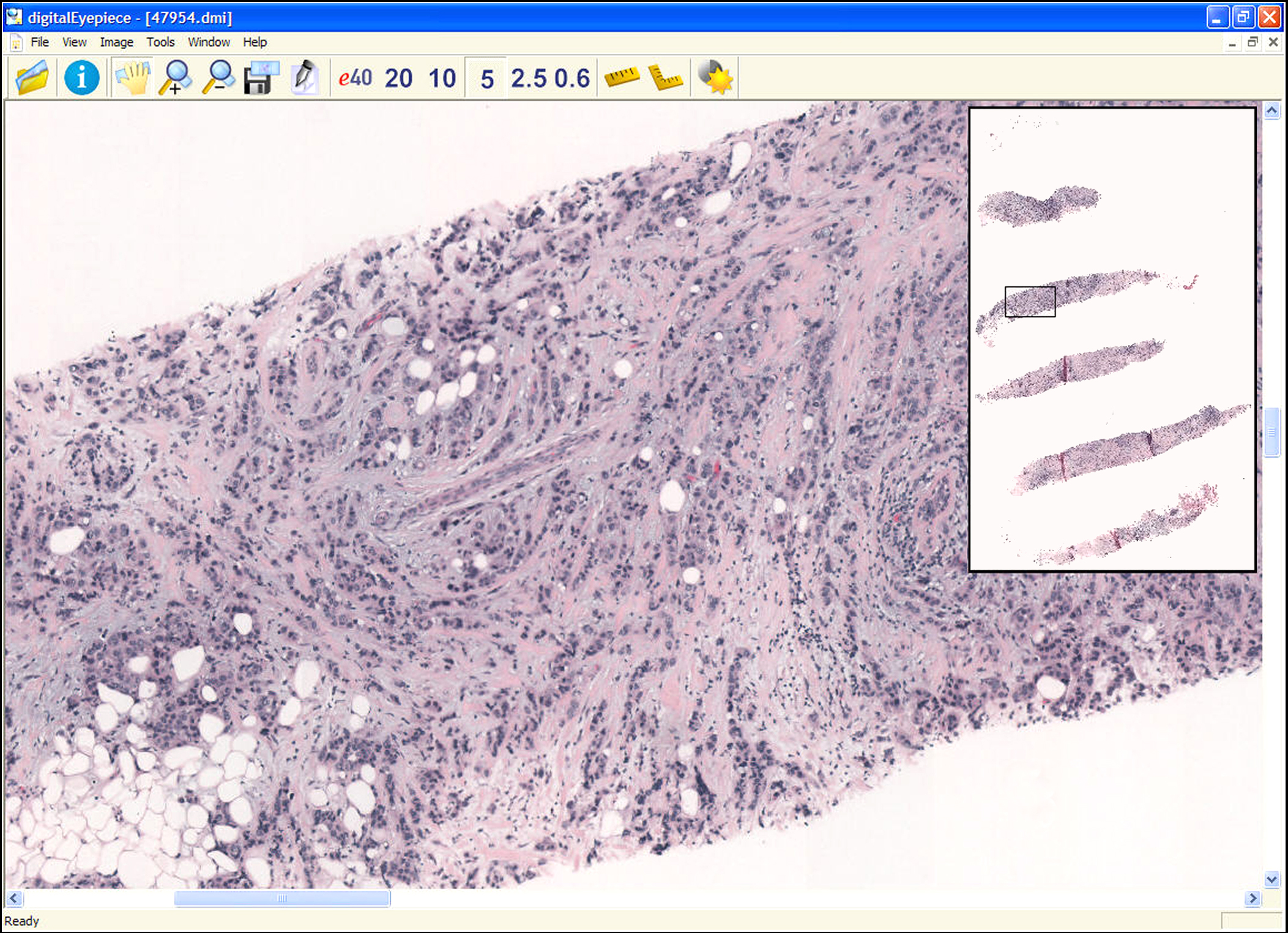 Five breast core biopsy samples processed into a virtual slide remotely accessible over a secure Internet site.