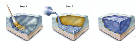 Diagram of CS adhesive and hydrogel application.