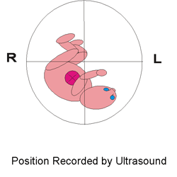 Cartoon indicating intrauterine fetal position during study