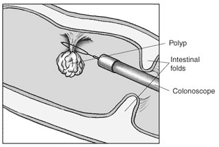 Drawing of a colon polyp being removed by a colonoscope with labels pointing to the polyp, colonoscope, and two intestinal folds. The wire loop at the end of the colonoscope is around the base of the polyp.