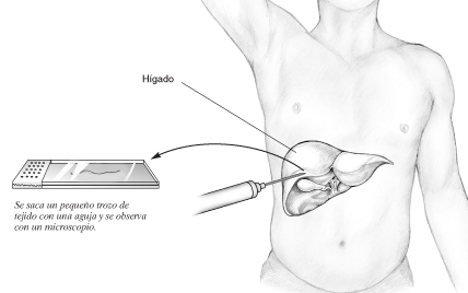 Imagen de una biopsia de hígado en la que la aguja para la biopsia es usada para extirpar una pequeña porción de tejido para examinarla bajo el microscopio.