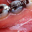 Close-up photograph of leukoplakia on a person's gums