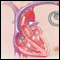 Illustration showing an implantable cardioverter-defibrillator (ICD)
