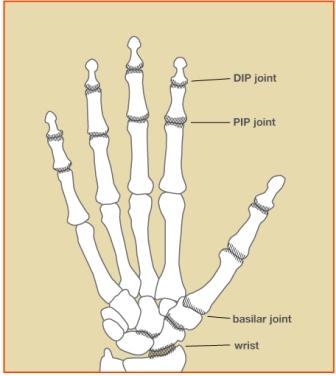 Hand joints affected by osteoarthritis