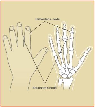 Osteoarthritis in finger joints