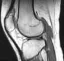MRI of the knee - side (lateral) view, showing distal or lowest part of femur, the patella (knee cap) and proximal (upper) tibia. The lateral meniscus is seen as a dark bow-tie like structure. The patellar tendon is also clearly seen at the front of the knee connecting the patella with the tibia.