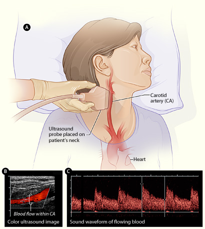 Illustration of carotid ultrasound