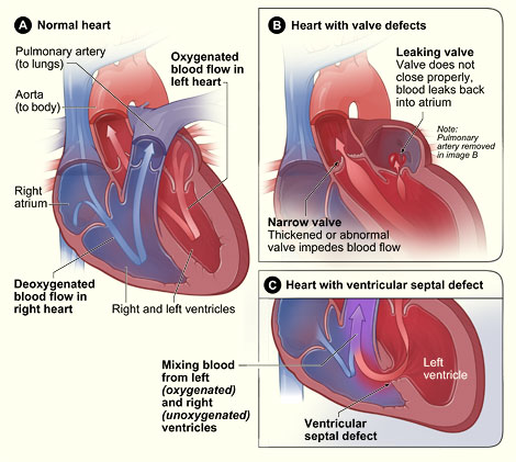 Illustration showing the normal anatomy and blood flow of the interior of the heart, a murmur caused by leaking and narrowed valves, and a murmur caused by a ventricular septal defect.