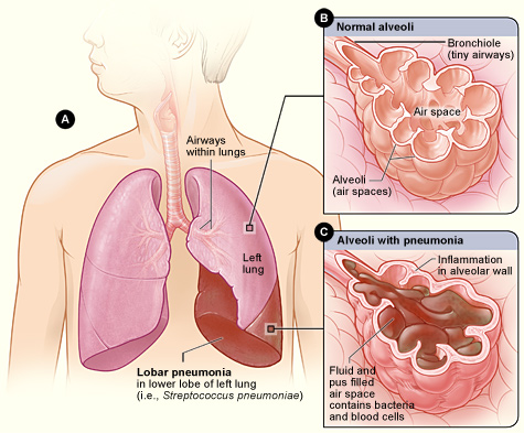 Illustration showing the anatomy of lobar pneumonia. Figure A shows the location of the lungs and airways in the body.  It also shows pneumonia that’s affecting the lower lobe of the left lung. Figure B shows normal alveoli.  Figure C shows infected alveoli.