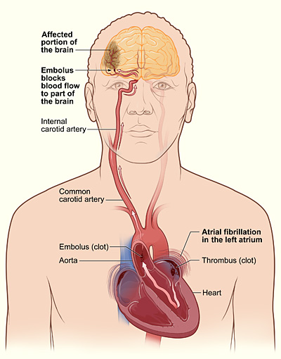 Illustration of how a stroke can occur during atrial fibrillation.