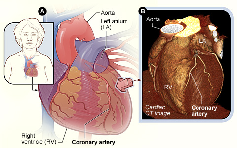 Illustration of a heart and a cardiac CT image.