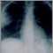 Aspergillosis - chest X-ray