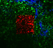 A mammary tumor in a living mouse as seen through a mammary imaging window. Tumor cells are green and optically-marked tumor cells are red. The extracellular matrix is blue. (Image courtesy of Dr. Jacco van Rheenen)