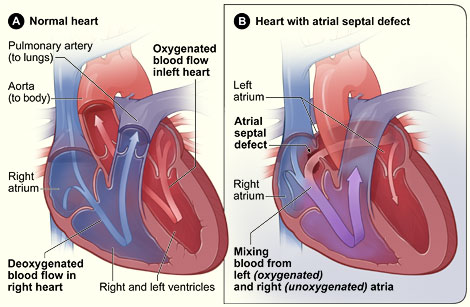 Normal Heart & Heart With Atrial Septal Defect