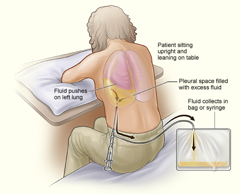 Illustration showing a person having thoracentesis.