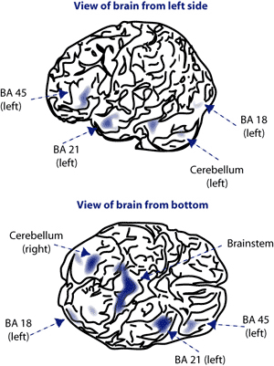 New Brain Imaging Technique Detects Brain Density Differences in MDMA Abusers