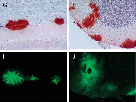 Abnormal prion proteins (red stain) also appear as plaques (green stain) in the brains of scrapie-infected mice expressing anchorless prion proteins.