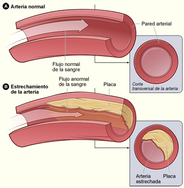La ilustración muestra una arteria normal con flujo normal de sangre (figura A) y una arteria que contiene depósitos de placa (figura B).