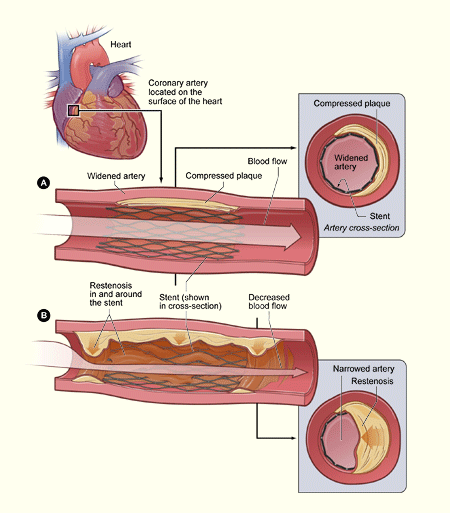 The illustration shows the restenosis of a stent-widened coronary artery.