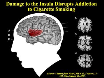 Damage to the insula disrupts addiction to cigarette smoking - see text 