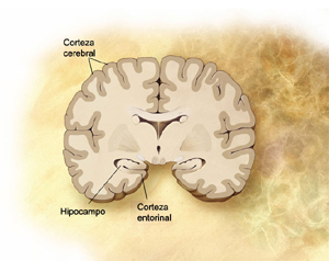 un ilustración del cerebro en Alzheimer pre-clínico