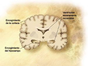 un ilustración del cerebro en Alzheimer leve