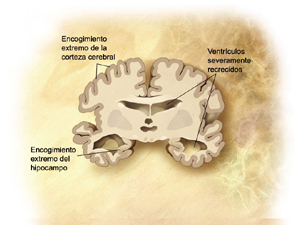 un ilustración del cerebro en Alzheimer severo