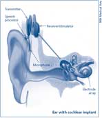 Illustration of cochlear implant.