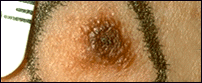 Picture of a dysplastic nevus illustrating rough texture