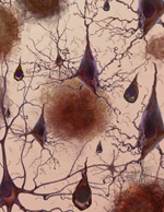The damage caused by AD: plaques, tangles, and the loss of connection between neurons