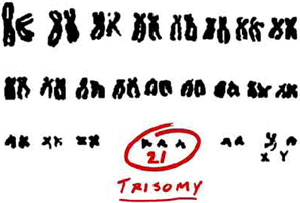 Trisomy, the hallmark of Down syndrome, results when a baby is born with three copies of chromosome 21 instead of the usual two.