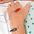 Electroacupuncture needles in arm