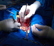 Photo of heart surgery.
