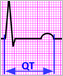 Illustration of an EKG graph.