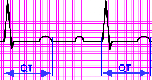 Illustration of an EKG graph showing the QT interval. 