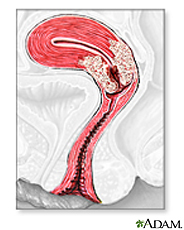 Illustration of uterine cancer