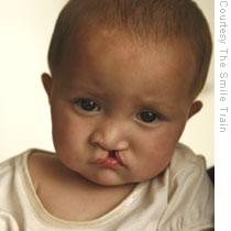 A child with a cleft in Kabul, Afghanistan. More than 25,000 children in Afghanistan are living with unrepaired clefts