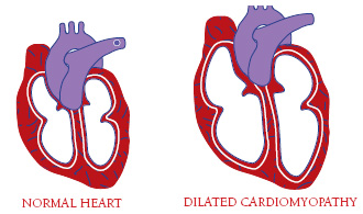 Normal and Dialated Heart